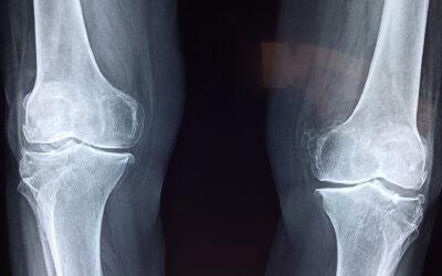 Method & System for Knee Joint Repair